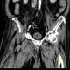 Fournier gangrene: CT - Computed tomography